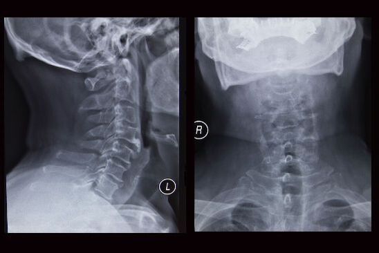 Servikal omurganın röntgen görüntüsü (hastada osteokondroz var)