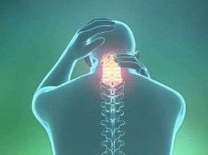 Servikal osteokondrozun bir belirtisi baş ağrısıdır. 