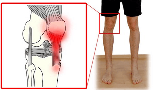 Tendinit, diz ekleminde ağrıya neden olan tendon dokusunun iltihaplanmasıdır. 