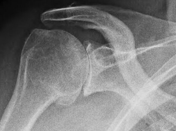 Artrozdan etkilenen omuz ekleminin röntgeni