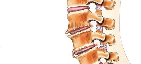 Spondiloz - İntervertebral eklemlerin yok edilmesi