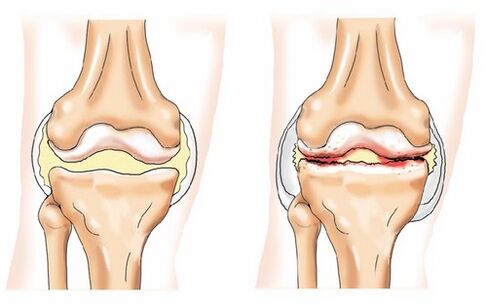Sağlıklı Eklem ve Arthroz