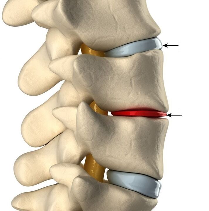 Sağlıklı bir disk ile osteokondrozlu bir disk arasındaki fark