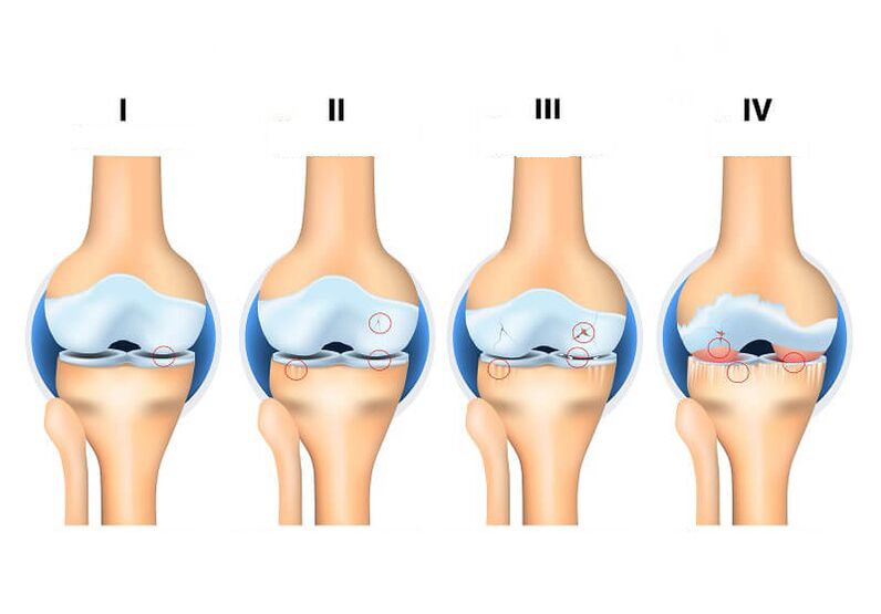 eklem artrozu aşamaları