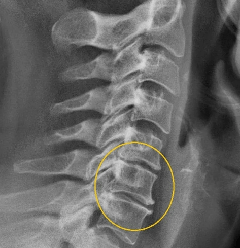 servikal osteokondroz