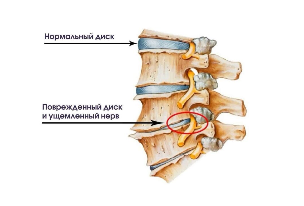 Servikal osteokondroz belirtileri