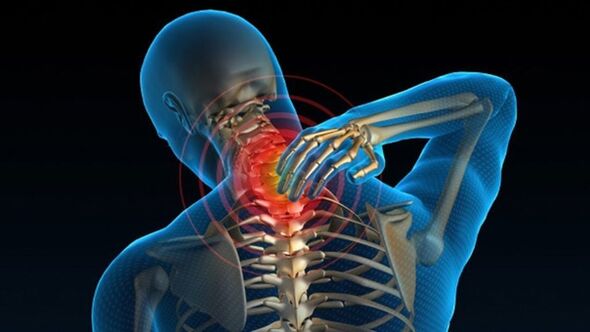 Boynu çevirirken ağrı, vertebral servikal osteokondroz sendromunu gösterebilir