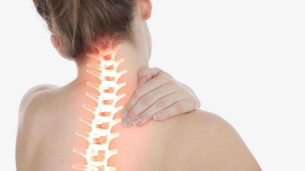 Servikal omurganın osteokondrozu ile radiküler sendrom gelişebilir
